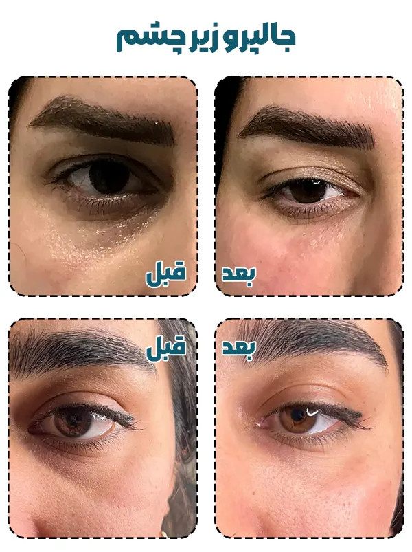 جالپرو زیر چشم یانگ ای کیفیت اصلی