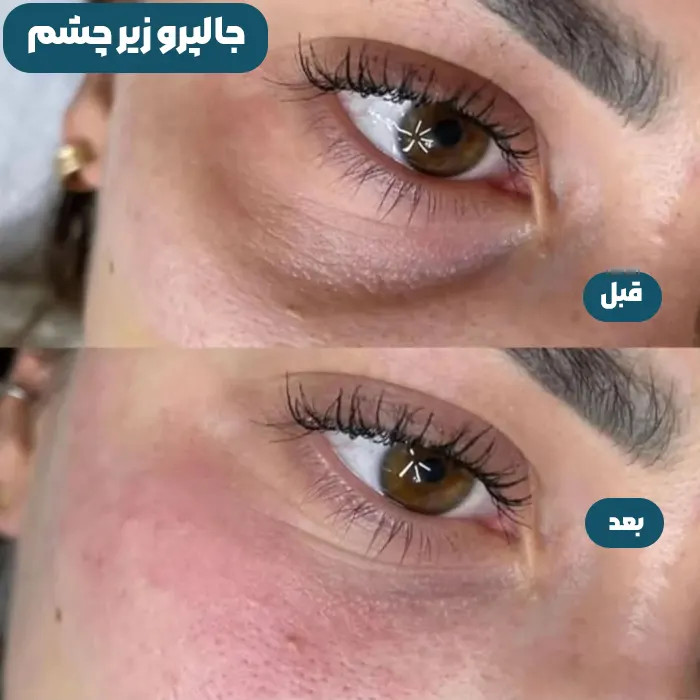 جالپرو زیر چشم یانگ ای کیفیت اصلی